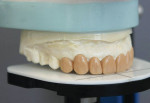 Figure 9: View of a wax-up on an articulatorh with a waxing guide.