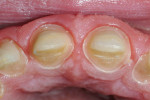 Figure 18  This view shows the patient’s superior tissue health at three months in temporaries. Taken immediately after removal without rinsing, the view clearly demonstrates the superior results that can be achieved with the use of an irrigato