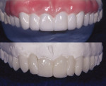 Figure 1B  Two different laboratories designed wax-ups for the case (dentistry performed by Dr. Anita Tate, private practice, Atlanta, Georgia).