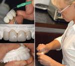 Figure 4B  A restorative dentist fabricated a multi-layer provisional using a cold curing acrylic.