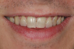 Figure 5A  This preoperative smile view demonstrates the shape and color of the teeth.Note that the midline is off center, and there is mild crowding.