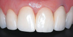 Figure 1  Maxillary lateral incisor with gingival recession following restoration.
