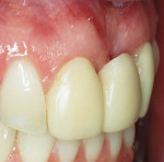 Figure 3  Preoperative photograph of alveolar ridge deficiency in the maxillary anterior region at the provisional restoration stage.