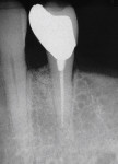 Figure 8  Radiograph of tooth No. 21 treatedusing a mineralized bone graft at 1 week shows 