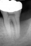 Figure 10  3-month postoperative x-ray of tooth No.18 treated using a demineralized bone graft shows no improvement in bone fill.