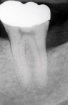 Figure 11  2-year postoperative x-ray of tooth No. 18 shows bone fill of defect on distal aspect.