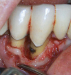 Figure 16  Surgical photograph of tooth No. 27 showing calculus and distal intrabony defect.