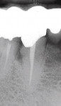 Figure 17  Preoperative radiograph of tooth No. 27 with bone loss evident on the distal.