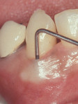 Figure 20  Clinical photograph of tooth No. 27 with buccal PD of 14 mm.