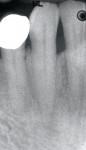 Figure 25  9-year postoperative radiograph of tooth No. 27 shows a resolution of the defect.