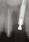 Figure 2  After implant placement, the X-ray suggests that without the planned surgical crown lengthening on the adjacent teeth, the implant crown would emerge substantially more apically than the adjacent natural teeth.