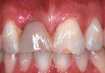 Figure 3  Preoperative image of tooth No. 8.