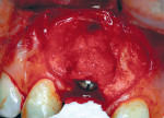 Figure 5  Surgical placement of implant with bone grafting as necessary.