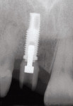 Figure 8  Abutment seated on implant.