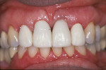 Figure 12  Provisionalization allows complete development of the soft tissue, evaluation of the incisal length, and final patient approval before moving to a final restoration.