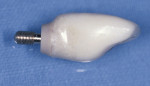 Figure 13   A correctly developed provisional on an implant will demonstrate a reduced subgingival contour unless there is a desire to push the tissue more apically.