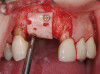 (8.) Preoperative left lateral, open view.
