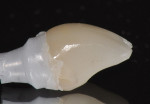 Figure 22  Retainedcement on a zirconia abutment, where the cement line was either not ideally positioned relative to the free gingival margin, or where a cementation technique that introduced cement subgingivally was used.
