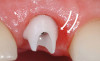 (25.) Provisionals, left lateral, closed view.