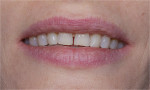Figure 1  The chief concern of this 28-year-old female patient was to enhance her dental esthetics and eliminate the central diastema.