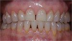 Figure 2  The intra-oral photograph demonstrates both the esthetic and functional diagnoses, including findings of collapse of vertical dimension and that there is a lack of posterior occlusion on the left side.