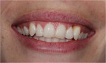 Figure 8  The high smile with the significant loss of papilla and 