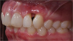 Figure 9  The high smile with the significant loss of papilla and 