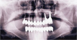 Figure 16  10-year results of periodontal-implant-prosthodontic reconstruction.