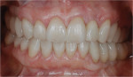 Figure 27  The healthy periodontal and dental implant foundation and gingival symmetry set the framework for the completion of the lithium disilicate all-ceramic restorations.