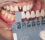 Figure 4  With the VITA Linearguide 3D-Master<sup>®</sup>, the new tab holder allows easier approximation to the teeth. .
