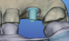 Fig 9 and Fig 10. An implant placed in site No. 10.