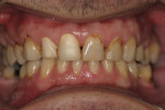Figure 5  Five days after initial whitening treatment, the patient presented for a coping try-in for the anterior crowns.