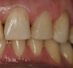 Figure 7  Caries control was performed on teeth Nos. 9, 10, and 11.