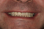 Figure 17  The patient was overwhelmingly satisfied with the results of the authors' work, which can be appreciated in this postoperative smile view of patient's maxillary arch treatment.