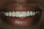 Figure 9  View of the composite restorations after the second appointment for finishing and refining.
