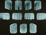 Figure 11  Preoperative periapical radiographs. Note that tooth No. 8 tested non-vital and has a history of trauma and fracture. It was also dark.