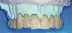 Figure 2  Smile design made to fit custom implant posts.