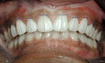 Figure 27  Postoperative evaluation of the final gingival zeniths  and axial contours.