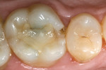 Figure 1  A patient presented with a defective composite restoration on the maxillary left first molar with recurrent decay.