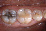 Figure 6  Preoperative occlusal view of a large composite resin restoration with recurrent decay on the mandibular right first molar.