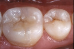 Figure 10  In this postoperative occlusal view of the laboratory processed composite resin restoration, note the harmonious integration of the composite resin with the existing tooth structure.