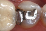 Figure 11  A patient presented with a fractured amalgam restoration with interproximal decay on a mandibular left second premolar.