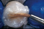 Figure 14  A sable brush was used to remove the excess resin cement, leaving only a residual amount at the margin to compensate for polymerization shrinkage.