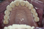 Figure 4  Occlusal view of the completed bridge.
