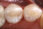 Figure 15  This postoperative view reveals the harmonious integration of interproximal form and color. Note the marginal adaptation of the indirect ceramic restoration.