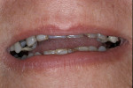 Figure 9  A 65-year-old patient presented with worn dentition.