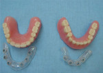 Figure 1  Upper palateless denture and lower denture with surgical stents.