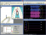 Figure 4  Posttreatment (1 hr after Figure 2A through Figure 2D) left excursion computerized occlusal analysis/EMG recording frame at muscle shutdown. Note the much shorter time distance between the numbers 3 and 4 postoperatively (top right panel).