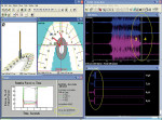 Figure 6  Two-week posttreatment computerized occlusal analysis/EMG recording. Note the similar appearance of both the occlusal contact data (only tooth No. 11 in contact) and the EMG muscular shutdown data (all four muscles reach resting state in 0.