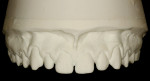 Figure 1  Maxillary cast showing slight buccal flare of canines and spacing postorthodontics.